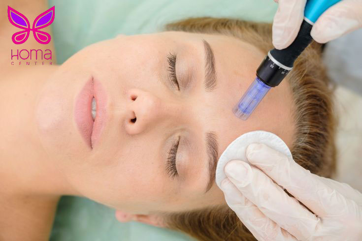 میکرونیدلینگ: روش نوین برای احیای پوست و مبارزه با چین و چروک