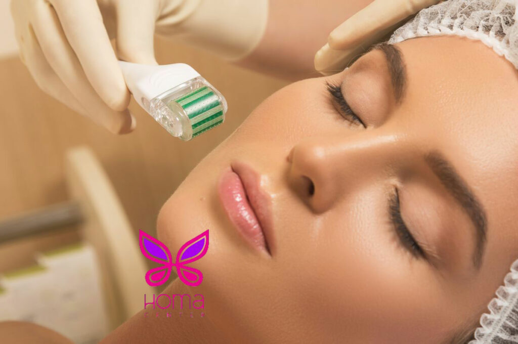 تاثیر میکرونیدلینگ بر جای جوش و لک‌ها