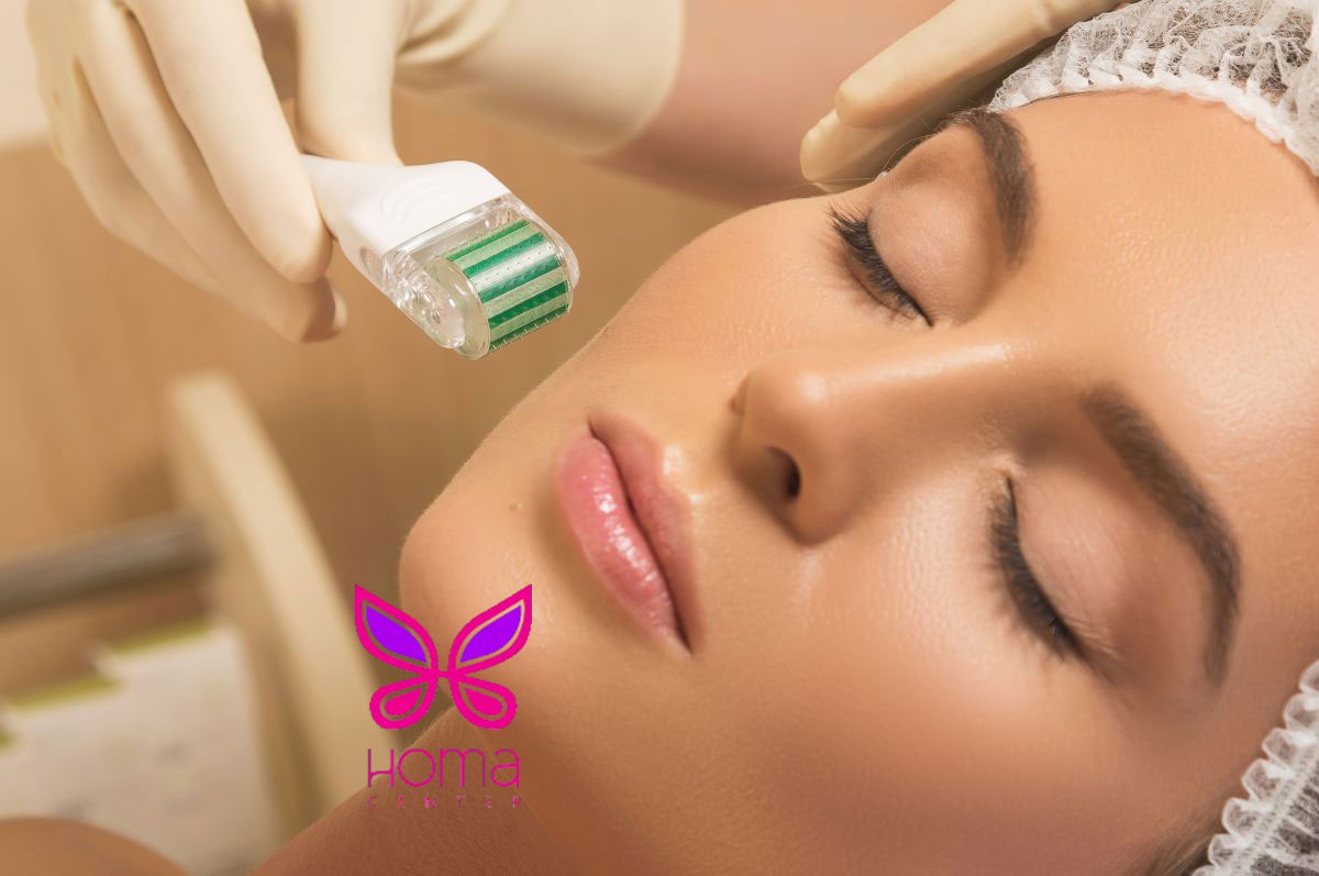 تاثیر میکرونیدلینگ بر جای جوش و لک‌ها